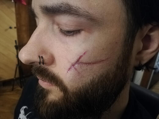 Scar test on myself